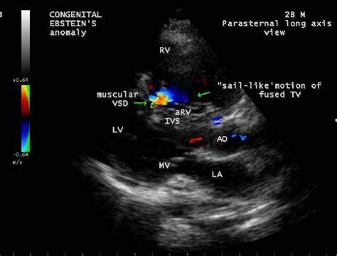 Parasternal Long Axis View Showing The Muscular Vsd Ventricular Septal
