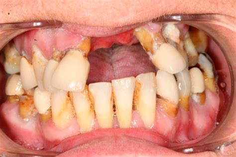 Woman Superglued Her Teeth In Because She Was Scared Of Dentists