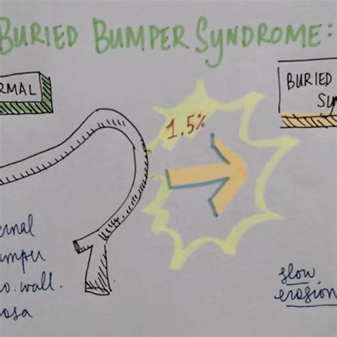 Mechanism Of Buried Bumper Syndrome Download Scientific Diagram