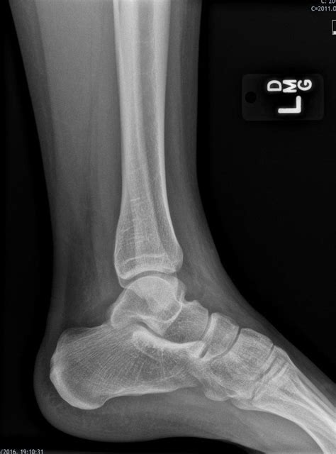 Normal Lateral Ankle Radiograph Image