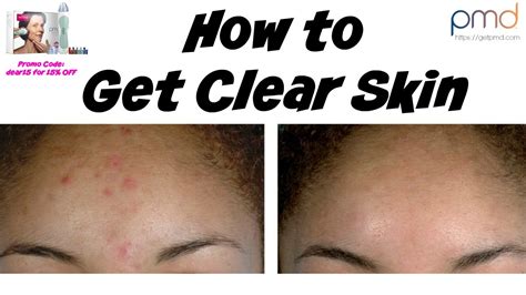 See full list on tractionbeauty.com HOW TO GET CLEAR SKIN FAST | PMD | Dearnatural62 - YouTube