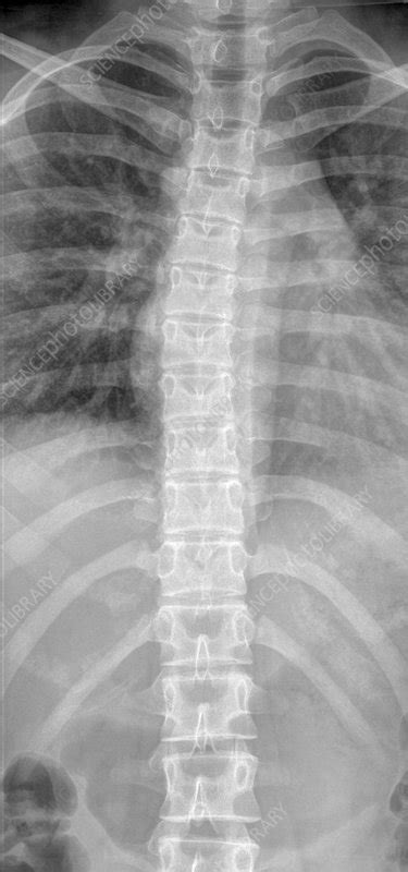 Normal spine and rib cage, X-ray - Stock Image C002/3273 - Science