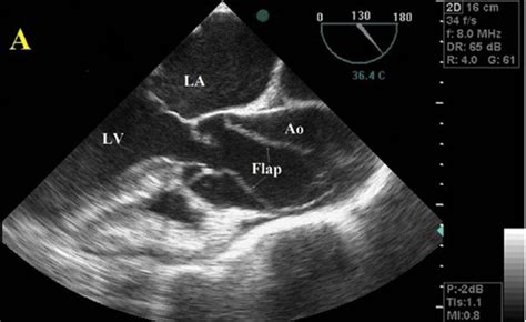 Aortic Dissection With Prolapse Of Flap Into The Ventricle Journal Of