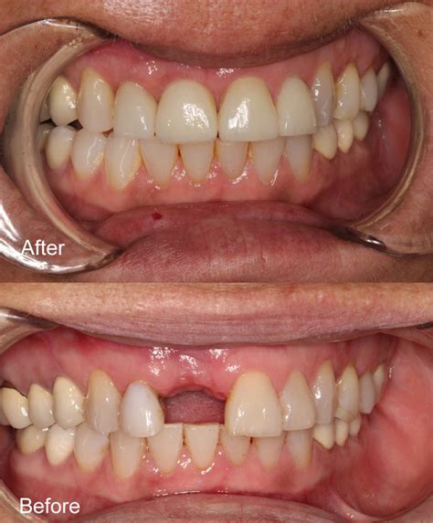 dental implants perth dental at joondalup