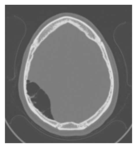 Ct Head In Bone Window Demonstrating Pneumocephalus Download