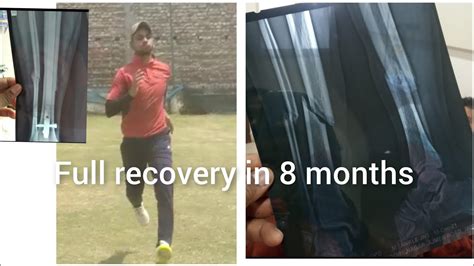 Full Recovery In 8 Month Tibia Fibula Fracture Return Ground Youtube