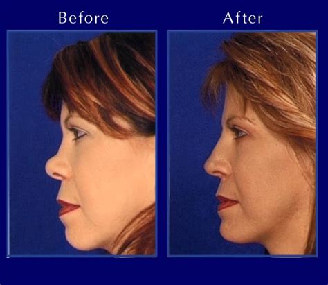 The Nose Clinic Before And After Nose Surgery Photos 19