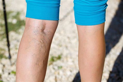 How To Prevent And Treat Varicose Veins