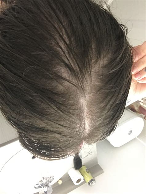 30 Yo Female Is My Hair Thinning Or Just Bad Lightening Its Wet