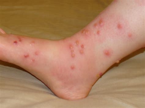 Using bleach on poison ivy, poison oak, and poison sumac. Homeopathy For Poison Ivy | Homeopathy Plus