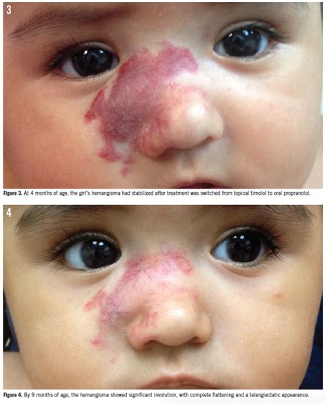 Infantile Hemangioma Management Of A Girls Growing Facial Lesion