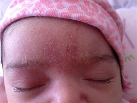 Dry Flaky Forehead Babycenter