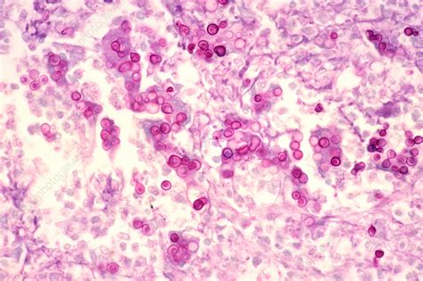 Blastomycosis In The Brain Stock Image C0052277 Science Photo Library
