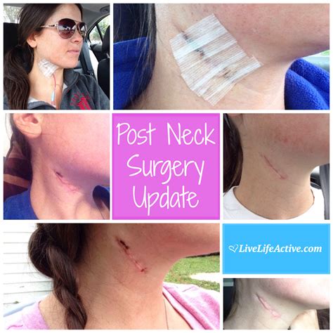 Post Neck Surgery Pictures Branchial Cleft Cyst Neck Disssection Scar