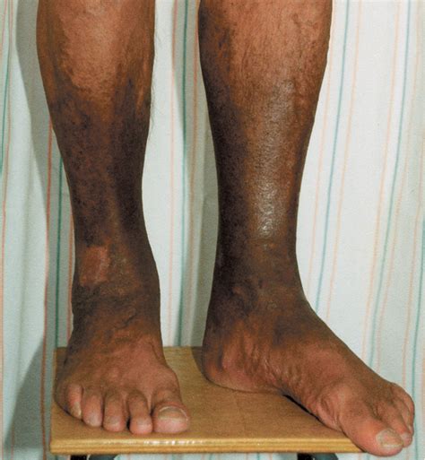 Brown Skin Discoloration On Lower Legs Dark Spots On Legs Diabetes