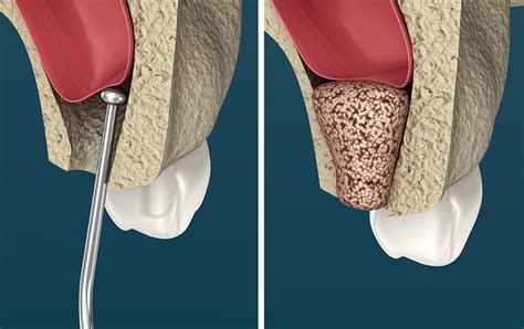 Sinus Lifts — Dr Zeb Mcnamara · Oral Dental Implant And Maxillofacial