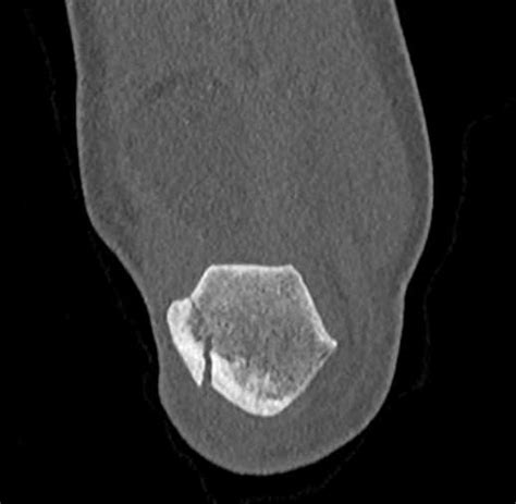 Patellar Fracture Trauma Case Studies Ctisus Ct Scanning