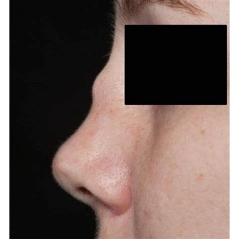 Acute Onset Saddle Nose Deformity Due To Inflammation Of The Nasal