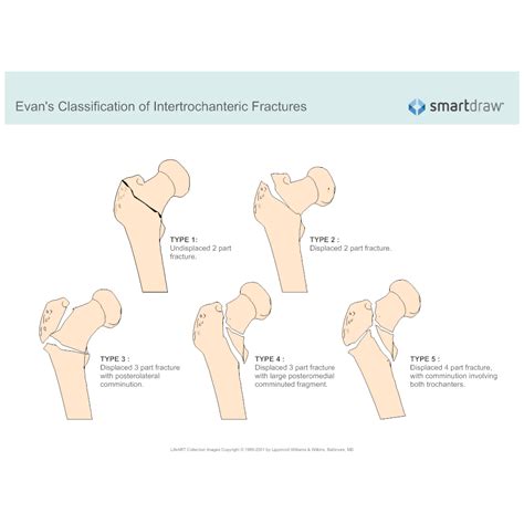 Evans Classification Of Intertrochanteric Fractures