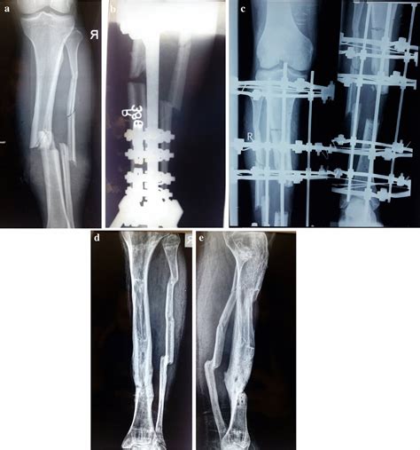 A Preoperative Radiograph Antero Posterior View Of Right Leg Showing