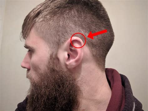 What You Need To Know About Cauliflower Ear In Bjj Project Bjj