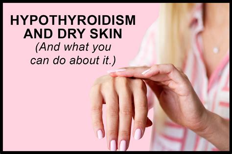 Dry Flaky Skin Is A Caused By Hypothyroidism Heres What You Can Do