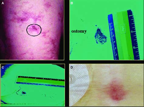 Skin Ulceration In Calciphylaxis Panel A Livedo Reticularis Anterior