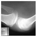 What the nails tell us / gregoriou s information on changes dystrophic nail plate noninfectious etiology in most common diseases in. Nail patella syndrome: a rare cause of renal failure in a ...