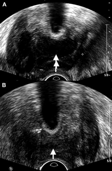 Transrectal Ultrasound Of The Prostate A Image With Two Hypoechoic