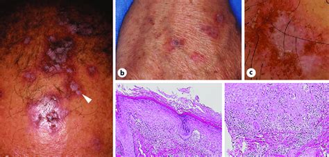 Clinical Features Of Lichen Planus In The Context Of Pembrolizumab