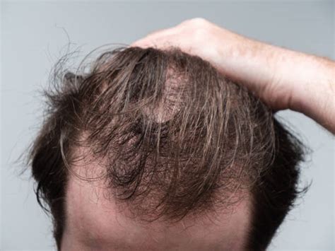 Bald Spot Photos Stock Photos Pictures And Royalty Free Images Istock