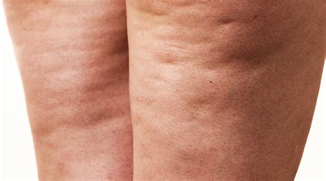 Low prices for cellulite removal in prague. Cellulite - Lebo Skin Care