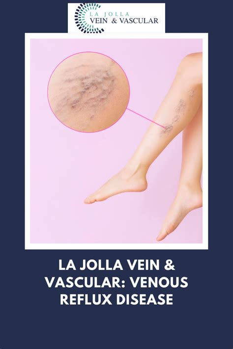 Venous Reflux Vein And Vascular Treatment