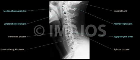 Spine Cervical Vertebrae C I C Vii Radiography Atlas C I