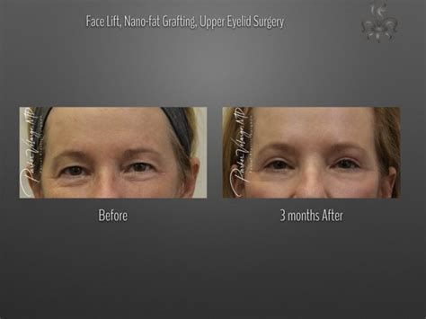 Blepharoplasty Eyelid Surgery Archives Page 6 Of 6 New Orleans