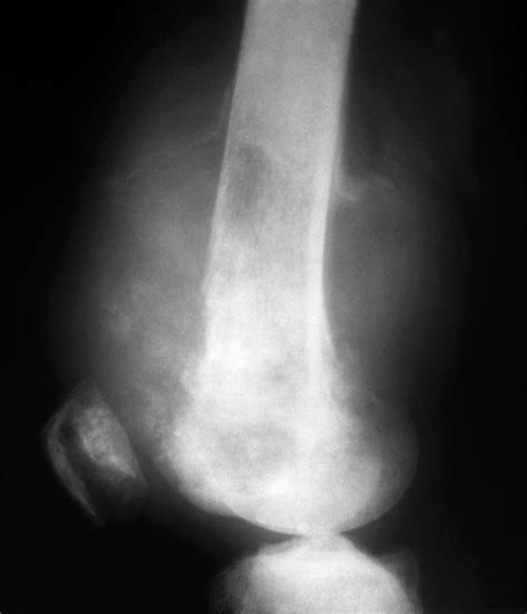 Bone Cancer In The Femur Photograph By Zephyrscience Photo Library