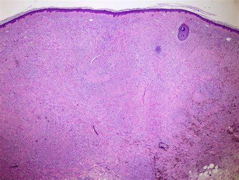 Pathology Outlines Cellular Blue Nevus
