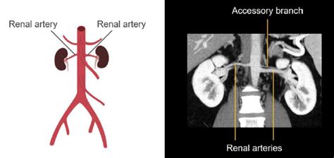 Abdominal Ct Abdominal Arteries • Litfl • Radiology Library