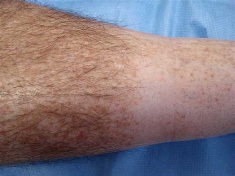 Clinically the patient suffered from progressive pigmented purpura (ppp). Virtual Grand Rounds in Dermatology - Primary Care ...