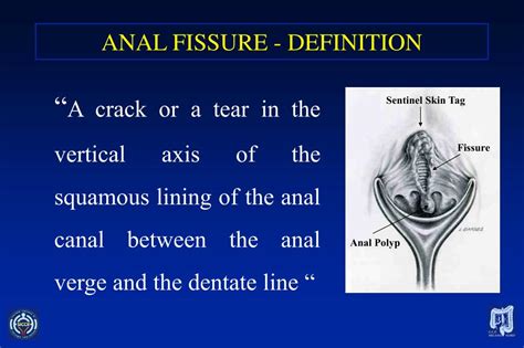 Ppt Treatment Of Anal Fissures Powerpoint Presentation Free Download