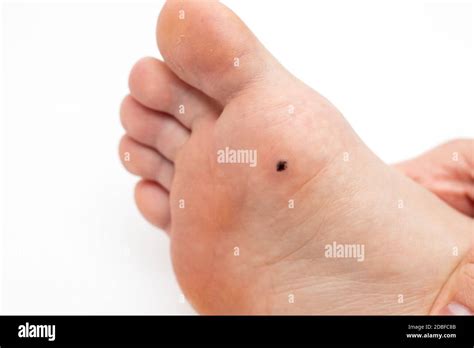 Plantar Wart Hi Res Stock Photography And Images Alamy