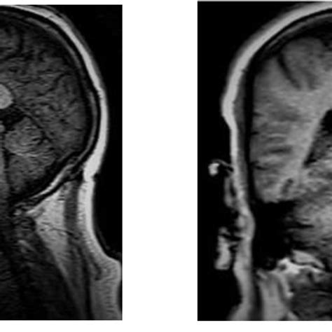 Brain Magnetic Resonance Imaging Mri Showing Bilateral Signal
