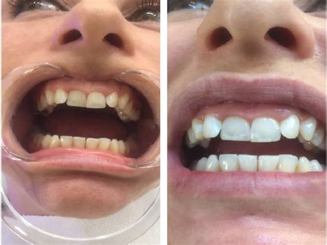 This natural whitening tooth powder is easily turn into a toothpaste using the bowl and spoon provided. Teeth whitening in Turkey and Istanbul, Price from 170