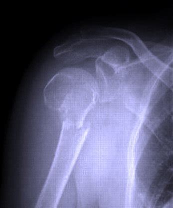 Le fratture di omero prossimale | MEDICITALIA.it
