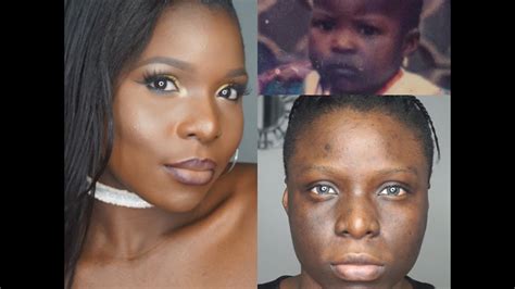 Best skin lightening cream for hyperpigmentation (dark spots). My Hyperpigmentation Story || Bleaching, Dealing With ...