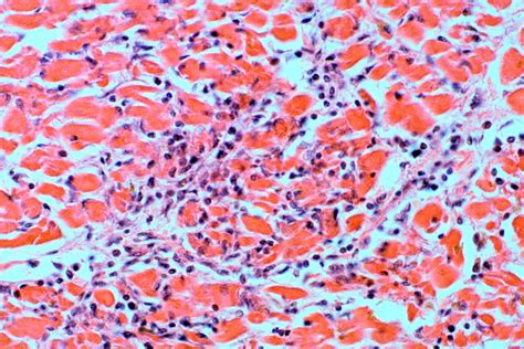 Myocarditides) is a general term referring to inflammation of the myocardium. Cardiovascular Pathology