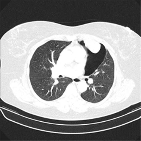 Primary Mediastinal Synovial Sarcoma A Case Report And Review Of The