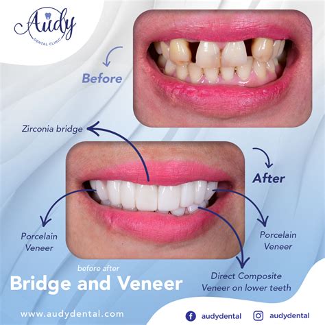 Solusinya adalah gigi palsu cekat berupa sarung gigi yang sering disebut crown ataupun bridge. Gigi Tiruan | Audy Dental