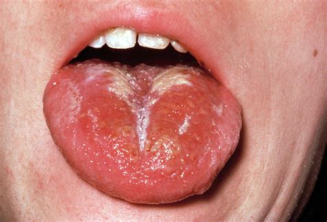 Scarlet Fever Rash On Tongue Photograph By Science Photo Library