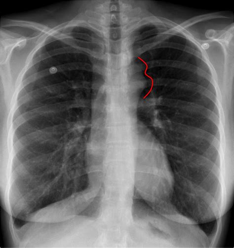 Radiology Signs • Figure 3 Sign A Chest Radiograph Sign Of Aortic